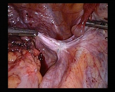 Endometriose pelvienne sur trajet uretere droit