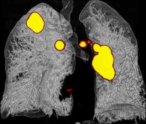 Cancer-pulmonaire.jpg