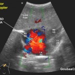 ECHO-DOPPLER-Coeur_CIA_echographie_echography_4EY00007