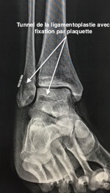 Tunnel de ligamentoplastie avec fixation par plaquette